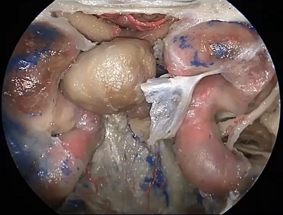 Intraoperative endoscopic view during skull base tumor surgery
