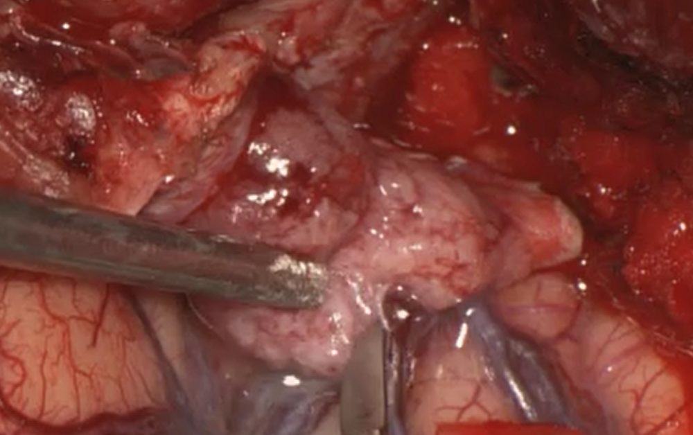 Intraoperative microscopic view during skull base tumor dissection