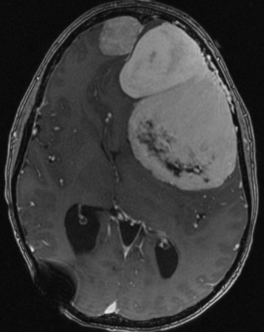 Axial MRI of a tumor with hemorrhage