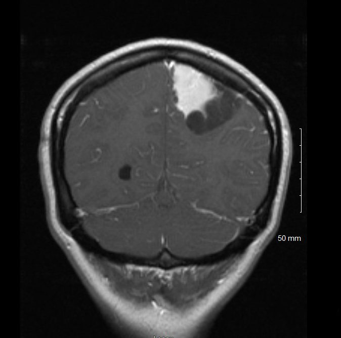 Coronal MRI of a tumor with hemorrhage