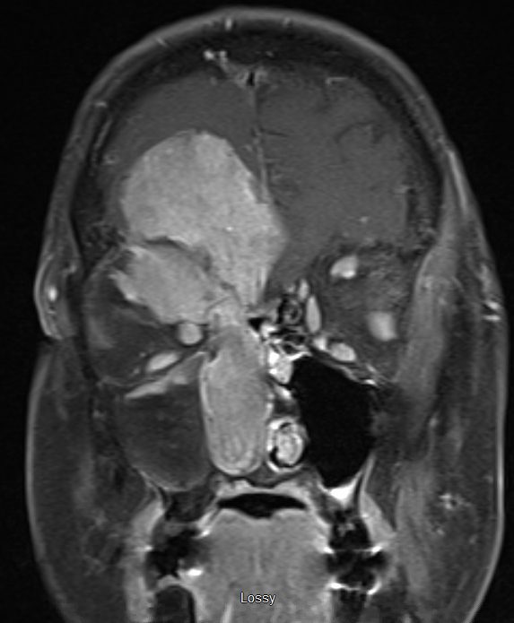 Axial MRI of a lateral skull base mass