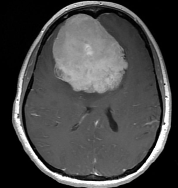 Axial MRI of a large convexity mass