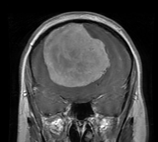 Coronal MRI of a large convexity mass