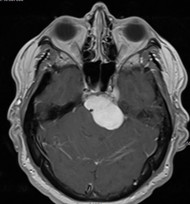 Axial MRI of a petroclival region lesion