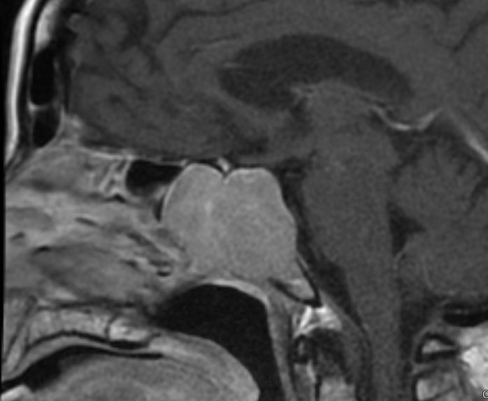 Sagittal MRI of a sellar region mass