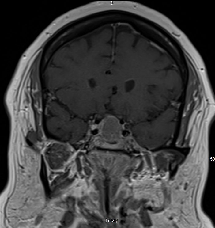 Coronal MRI of a skull base mass